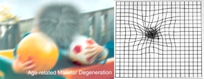 A scene as viewed by a person with the form of age-related macular degeneration known as dry AMD (left). To someone with wet AMD, straight lines appear wavy, as shown by the Amsler grid on the right. (Images: National Eye Institute, National Institutes of Health) A scene as viewed by a person with the form of age-related macular degeneration known as dry AMD (left). To someone with wet AMD, straight lines appear wavy, as shown by the Amsler grid on the right. (Images: National Eye Institute, National Institutes of Health)